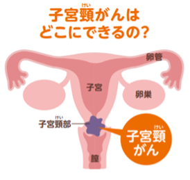 子宮頸がんはどこにできるの？